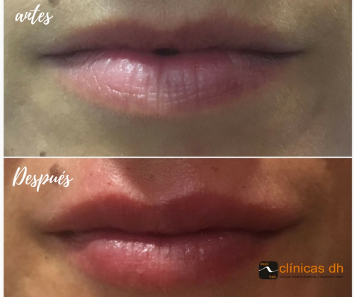 Aumento de labios